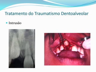 Tratamento do Traumatismo Dentoalveolar
 Intrusão
 