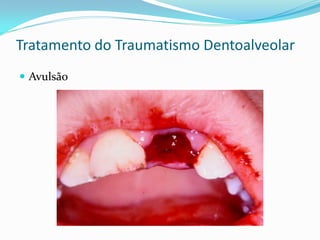 Tratamento do Traumatismo Dentoalveolar
 Avulsão
 