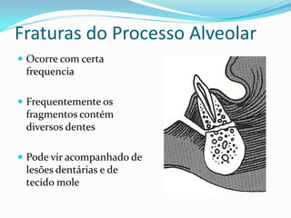 Fraturas do Processo Alveolar
 Ocorre com certa
frequencia
 Frequentemente os
fragmentos contém
diversos dentes
 Pode vir acompanhado de
lesões dentárias e de
tecido mole
 