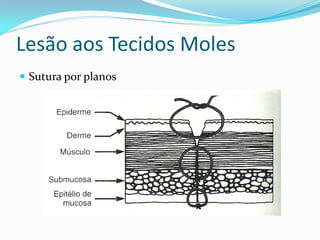 Lesão aos Tecidos Moles
 Sutura por planos
 