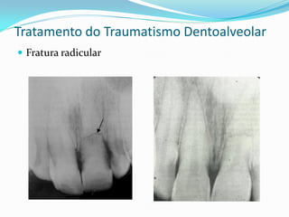 Tratamento do Traumatismo Dentoalveolar
 Fratura radicular
 