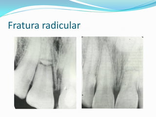 Fratura radicular
 