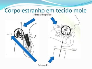 Corpo estranho em tecido mole
          Filme radiográfico




              Feixe de Rx
 