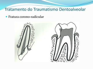 Tratamento do Traumatismo Dentoalveolar
 Fratura corono-radicular
 