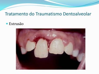 Tratamento do Traumatismo Dentoalveolar
 Extrusão
 