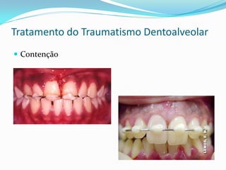 Tratamento do Traumatismo Dentoalveolar
 Contenção
 