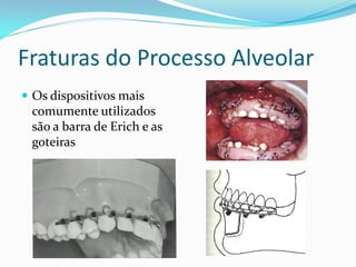 Fraturas do Processo Alveolar
 Os dispositivos mais
 comumente utilizados
 são a barra de Erich e as
 goteiras
 