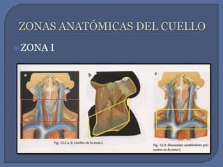 ZONAS ANATÓMICAS DEL CUELLOZONA I