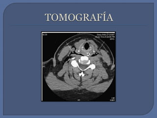 TOMOGRAFÍA