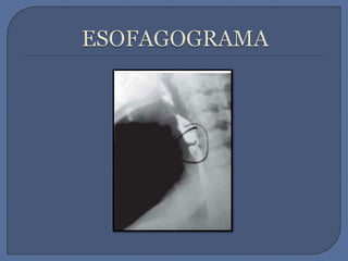 ESOFAGOGRAMA