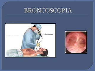 BRONCOSCOPIA