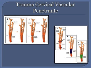 Trauma Cervical Vascular Penetrante