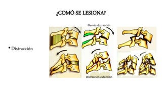 ¿COMÓ SE LESIONA?
•Flexión•Extensión•Compresión•Rotación
Rotación y flexión Rotación y hiperextensión
•Flexión lateral•Distracción
Distraccion extension
Flexión distracción
 