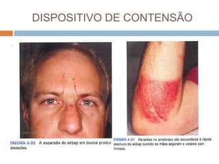 DISPOSITIVO DE CONTENSÃO
 AIRBAG - devem ser sempre usados em
combinação com cintos de segurança para fornecer
proteção máxima ao ocupante do veículo.
Originalmente, os sistemas de airbag para o
motorista e o passageiro do banco da frente foram
projetados para amortecer o movimento para a
frente. Os airbag absorvem lentamente a energia,
aumentando a distância de parada do corpo são
muito eficientes na primeira colisão de impactos
frontais e quase frontais
 