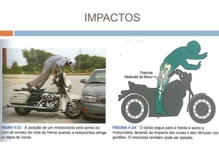 IMPACTOS
 Impacto Frontal - Uma vez que seu centro de gravidade
se encontra acima e atrás do eixo da frente, que é o
ponto fixo nessa colisão, a motocicleta tomba para a
frente e o motociclista colide com o guidão. O
motociclista pode sofrer lesões no crânio, no tórax, no
abdome ou na pelve, dependendo da parte do corpo
que colidir com o guidão.
 