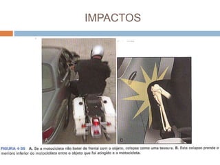 IMPACTOS
 Impacto Angular - Na colisão com impacto
angular, a motocicleta atinge o objeto em
ângulo. A motocicleta cai sobre o motociclista,
ou prensa-o entre o veículo e o objeto que foi
atingido. Podem ocorrer lesões nos membros
superiores ou inferiores, o que resulta em
fratura e lesão extensa de partes moles.
 