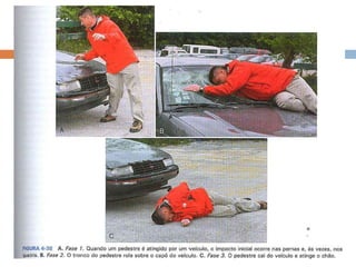 ATROPELAMENTO
 Existem três etapas distintas na colisão entre pedestre e
veículo motorizado. Cada etapa possui seu padrão de
lesão:
1. O impacto inicial é nas pernas e às vezes nos quadris
(Fig.4-38A).
2. O tronco rola sobre o capô do carro (e pode bater no
pára-brisa)(Fig. 4-38B).
3. A vítima cai do carro no asfalto, geralmente de
cabeça,com possível trauma da coluna cervical (Fig. 4-
38C).
 