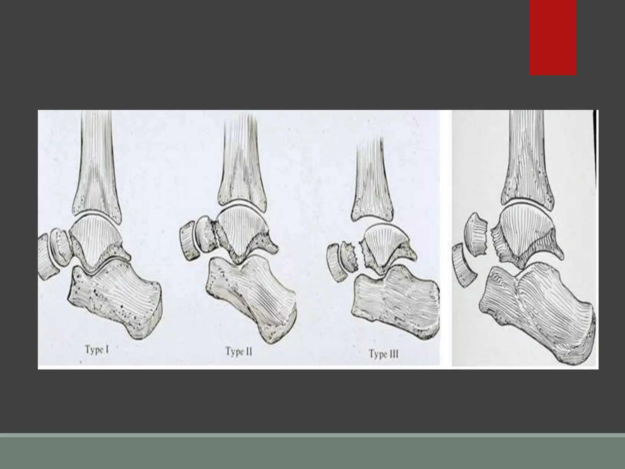 Talar Break TRAUMA CON-TALAR FRACTURES.pptx