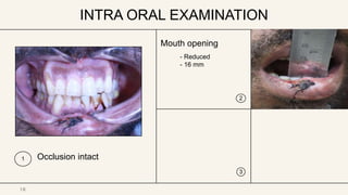 INTRA ORAL EXAMINATION
1 Occlusion intact
Mouth opening
- Reduced
- 16 mm
2
3
1
2
1 0
 