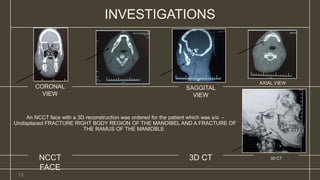 An NCCT face with a 3D reconstruction was ordered for the patient which was s/o -
Undisplaced FRACTURE RIGHT BODY REGION OF THE MANDIBEL AND A FRACTURE OF
THE RAMUS OF THE MANIDBLE .
CORONAL
VIEW
SAGGITAL
VIEW
AXIAL VIEW
3D CT
1 2
NCCT
FACE
3D CT
INVESTIGATIONS
 