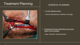 Treatment Planning SURGICAL PLANNING
 Undisplaced Fracture Right Body and ramus
region of the mandible.
- Open reduction, Internal fixation.
1 4
 For the infected wound.
- Wound Debridement, Antibiotic coverage.
 