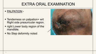 EXTRA ORAL EXAMINATION
7
 PALPATION:-
 Tenderness on palpation+ wrt
Right side preauricular region.
 right Lower body region of the
mandible.
 No Step deformity noted
 