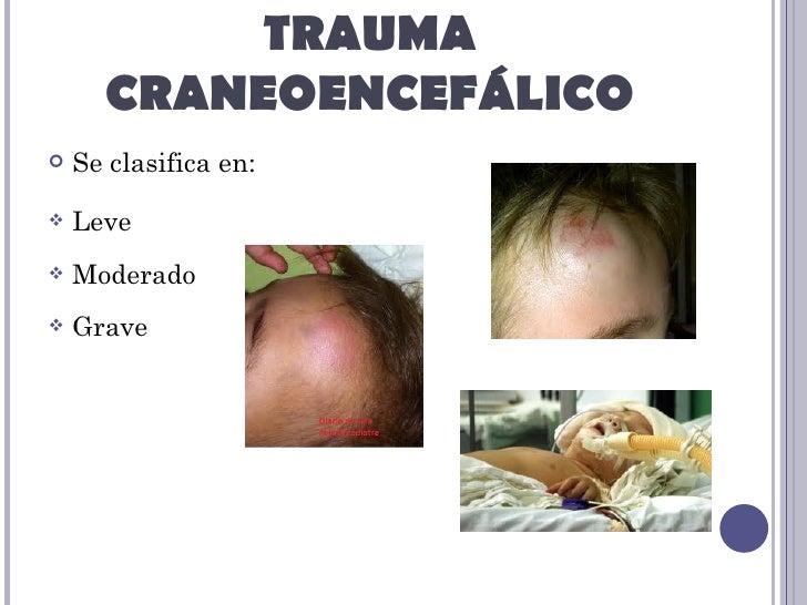 Trauma craneoencefalico Trauma craneoencefalico