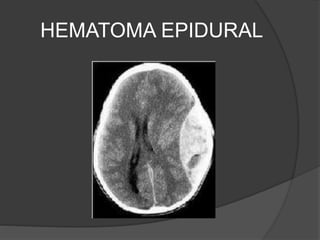 HEMATOMA EPIDURAL
 