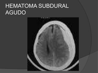 HEMATOMA SUBDURAL
AGUDO
 