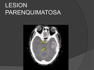 LESION
PARENQUIMATOSA
 