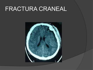 FRACTURA CRANEAL
 