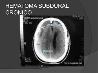 HEMATOMA SUBDURAL
CRONICO
 