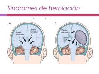 Síndromes de herniación
 