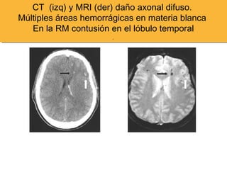 CT (izq) y MRI (der) daño axonal difuso.
Múltiples áreas hemorrágicas en materia blanca
En la RM contusión en el lóbulo temporal
.
CT (izq) y MRI (der) daño axonal difuso.
Múltiples áreas hemorrágicas en materia blanca
En la RM contusión en el lóbulo temporal
.
 