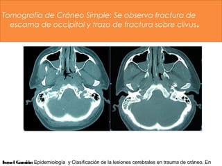 Tomografía de Cráneo Simple: Se observa fractura de
escama de occipital y trazo de fractura sobre clivus.
Israel Gamiño Epidemiología y Clasificación de la lesiones cerebrales en trauma de cráneo. En
 