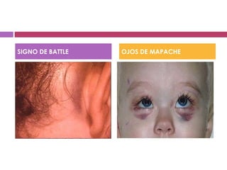  Si se extiende más
hacia atrás, el
tejido que está
por detrás del
oído y sobre la
apófisis mastoides
se abulta y
cambia de color
 La fractura de la
parte anterior de
la base de cráneo
puede hacer que
se fugue sangre
hacia los tejidos
periorbitarios
SIGNO DE BATTLE OJOS DE MAPACHE
 