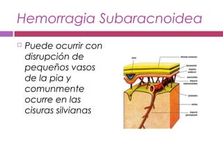 Hemorragia Subaracnoidea
 Puede ocurrir con
disrupción de
pequeños vasos
de la pia y
comunmente
ocurre en las
cisuras silvianas
 