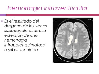 Hemorragia intraventricular
 Es el resultado del
desgarro de las venas
subependimarias o la
extensión de una
hemorragia
intraparenquimatosa
o subaracnoidea
 