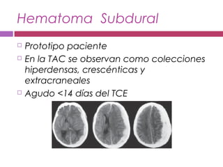 Hematoma Subdural
 Prototipo paciente
 En la TAC se observan como colecciones
hiperdensas, crescénticas y
extracraneales
 Agudo <14 días del TCE
 