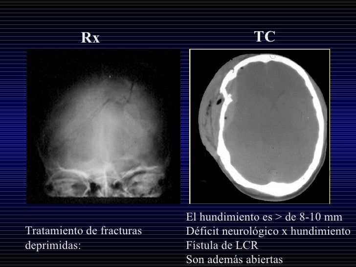 Trauma Craneoencefalico AS