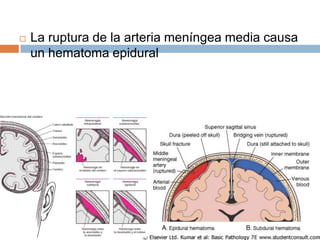    La ruptura de la arteria meníngea media causa
    un hematoma epidural
 