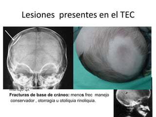 Lesiones presentes en el TEC
Heridas de cuero cabelludo: pueden ser de mayor o menor grado se
debe buscar fx sangrado presencia de LCR puede causar choque
hipovolemico .
Fracturas de cráneo: no implican lesión c grave son indicación de
observación.
Fracturas lineales: son grietas sin desplazamiento de estructuras
óseas a través del cráneo
Fracturas deprimidas: son aquellas que desplazan
el hueso. Menos frec 7-10% cursan con alteración
Dela duramadre, déficit neurologico,fistula de LCR
Manejo qx
Fracturas de base de cráneo: menos frec manejo
conservador , otorragia u otoliquia rinoliquia.

 