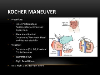 • Procedure:
• Incise Posterolateral
Peritoneal Attachments of
Duodenum
• Place Hand Behind
Duodenum/Pancreatic Head
and Retract Medially
• Visualize:
• Duodenum (D1, D2, Proximal
D3) & Pancreas
• Suprarenal IVC
• Right Renal Hilum
• Risk: Right Gonadal Vein Injury
KOCHER MANEUVER
 