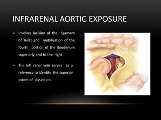  Involves incision of the ligament
of Treitz and mobilization of the
fourth portion of the duodenum
superiorly and to the right
 The left renal vein serves as a
reference to identify the superior
extent of dissection.
INFRARENAL AORTIC EXPOSURE
 