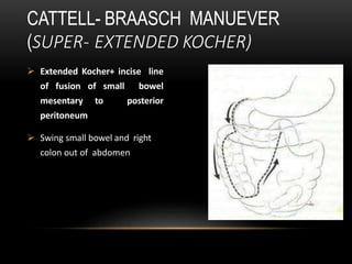  Extended Kocher+ incise line
of fusion of small bowel
mesentary to posterior
peritoneum
 Swing small bowel and right
colon out of abdomen
CATTELL- BRAASCH MANUEVER
(SUPER- EXTENDED KOCHER)
 