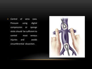  Control of vena cava.
Pressure using digital
compression or sponge
sticks should be sufficient to
control most venous
injuries and avoids
circumferential dissection.
 