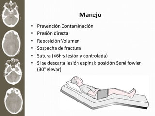 Manejo
• Prevención Contaminación
• Presión directa
• Reposición Volumen
• Sospecha de fractura
• Sutura (<6hrs lesión y controlada)
• Si se descarta lesión espinal: posición Semi fowler
(30° elevar)
 