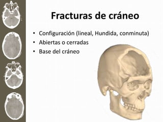 Fracturas de cráneo
• Configuración (lineal, Hundida, conminuta)
• Abiertas o cerradas
• Base del cráneo
 