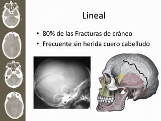 Lineal
• 80% de las Fracturas de cráneo
• Frecuente sin herida cuero cabelludo
 