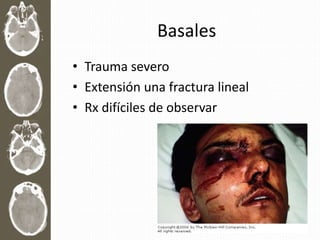 Basales
• Trauma severo
• Extensión una fractura lineal
• Rx difíciles de observar
 